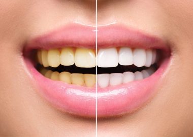 Benefits of Teeth Whitening - Calgary Dentist