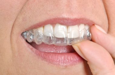 Invisalign Clear Braces Treatment for an Underbite in NYCDr. Jacquie