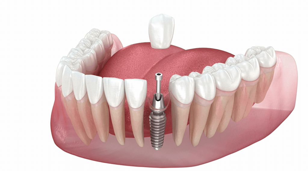 Why Are Dental Implants A Popular Choice For Tooth Replacement?