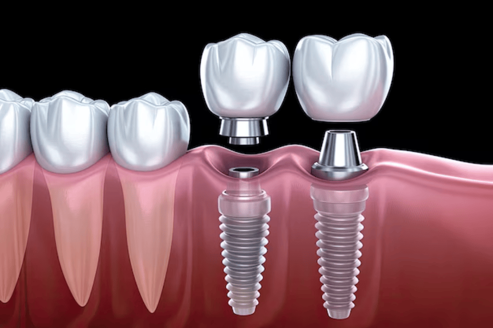 tooth implant process what to expect